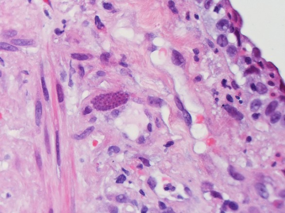 Toxoplasmosi bradizoiti